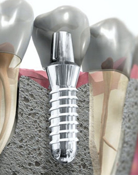 Implantology