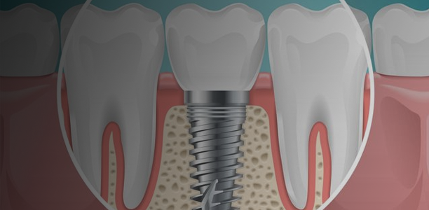 Dental Implants